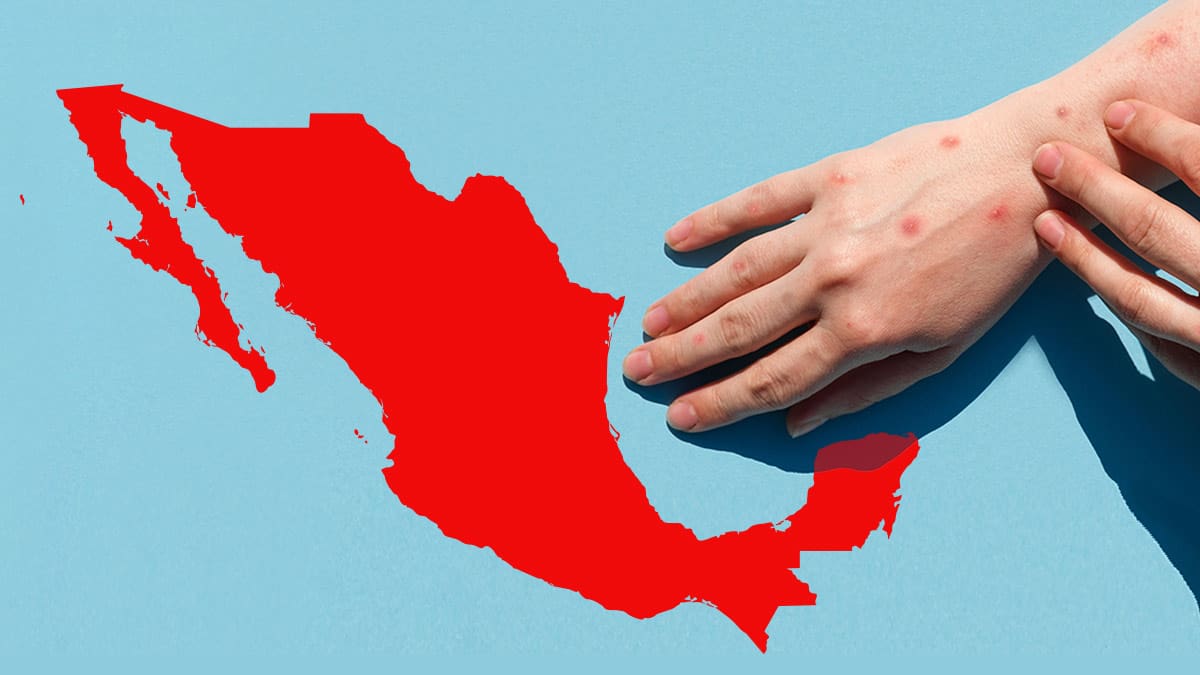 Brote de sarampión sigue sin control en varios estados del país