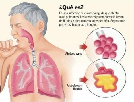 Hay casi 8 mil casos confirmados de Neumonias y Bronconeumonías en la entidad